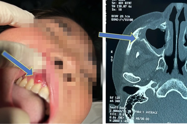 Hoại tử xương sau khi mắc COVID-19: Đừng quá lo vì những chuyện quá hiếm-3