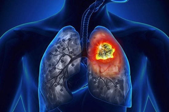 7 bệnh ung thư nguy hiểm: Dấu hiệu cảnh báo sớm bạn cần nhớ