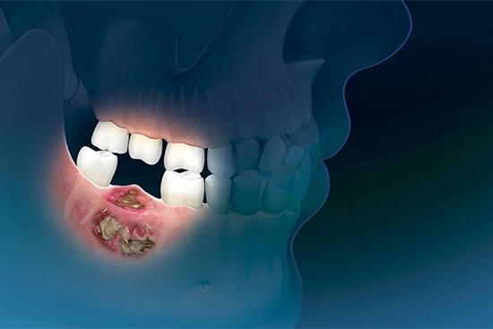 Hoại tử xương sau khi mắc COVID-19: 