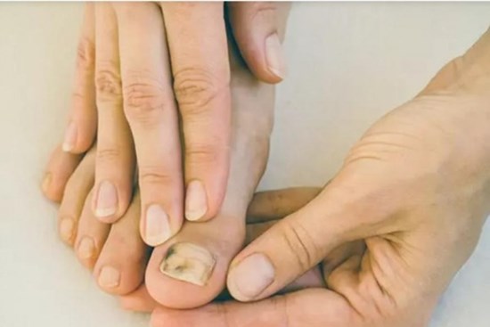 Bất thường ở móng tay cảnh báo loại ung thư da nguy hiểm nhất