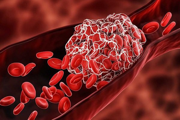 2 bộ phận thường xuyên bị đau là dấu hiệu mạch máu bị tắc nghẽn, bỏ qua nghĩa là đánh mất cơ hội tự cứu mình-1