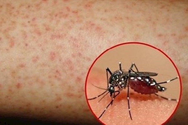 Một tuần tăng hơn 10.000 ca mắc sốt xuất huyết, 2 người tử vong-1