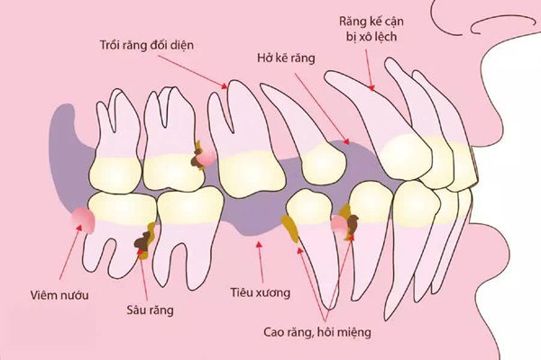 Tiêu xương và hoại tử xương hàm mặt: Chữa càng sớm càng ít nguy biến-2