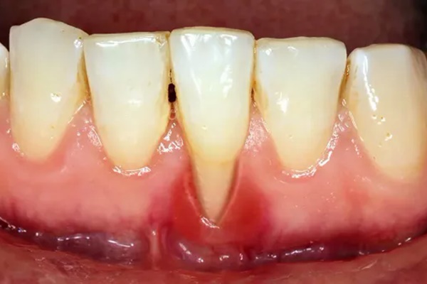 Hội đồng chuyên môn kết luận về các bệnh nhân bị hoại tử xương hàm mặt sau nhiễm COVID-19-3