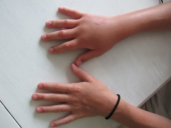 6 dấu hiệu trên bàn tay đang ám chỉ rằng lượng đường trong máu đã quá cao nhưng hầu hết chúng ta đều xem nhẹ-4