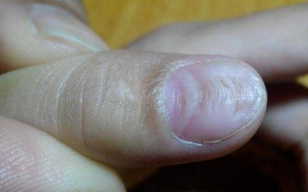 6 dấu hiệu trên bàn tay đang ám chỉ rằng lượng đường trong máu đã quá cao nhưng hầu hết chúng ta đều xem nhẹ-6