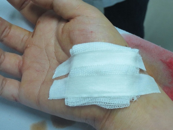 6 dấu hiệu trên bàn tay đang ám chỉ rằng lượng đường trong máu đã quá cao nhưng hầu hết chúng ta đều xem nhẹ-7