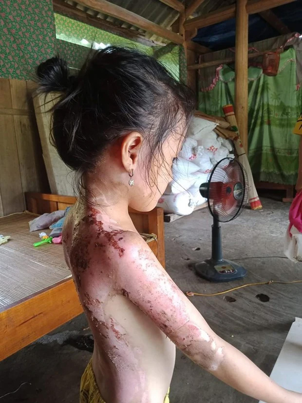 Phú Thọ: Công an vào cuộc vụ bé gái bị hàng xóm dội cả ấm nước sôi vào người-1
