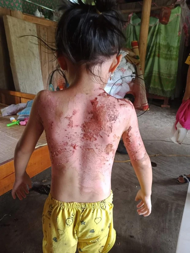 Phú Thọ: Công an vào cuộc vụ bé gái bị hàng xóm dội cả ấm nước sôi vào người-2
