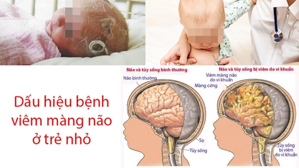 Những dấu hiệu nào báo hiệu bệnh viêm màng não ở trẻ em?-1