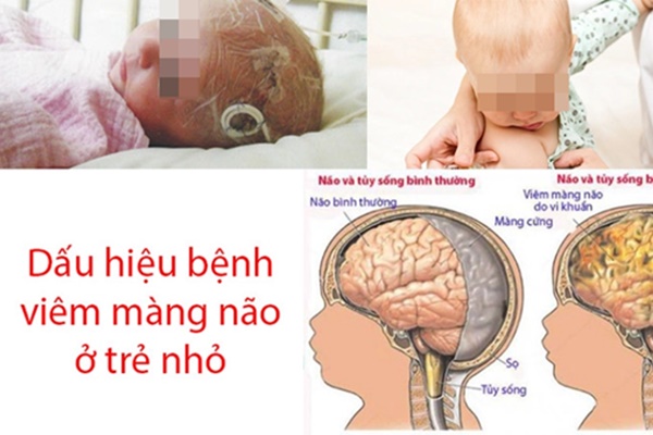 Nhiều trẻ nhập viện vì viêm não, viêm màng não nặng-2