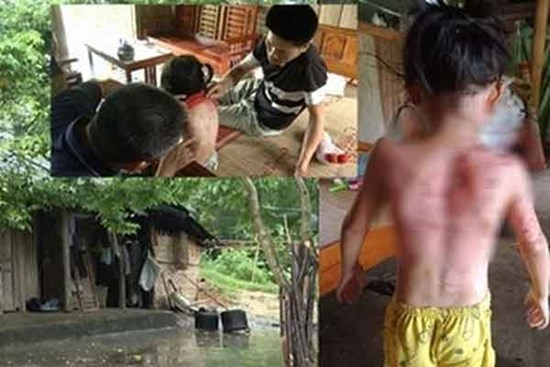 Hoàn cảnh đáng thương của gia đình cháu bé bị hàng xóm dội nước sôi vào người