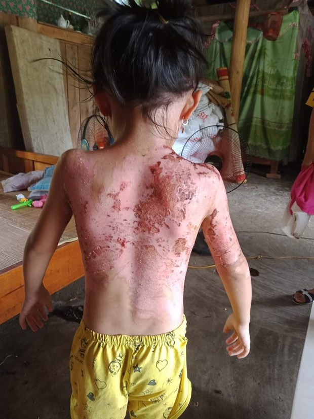 Hoàn cảnh đáng thương của gia đình cháu bé bị hàng xóm dội nước sôi vào người-3
