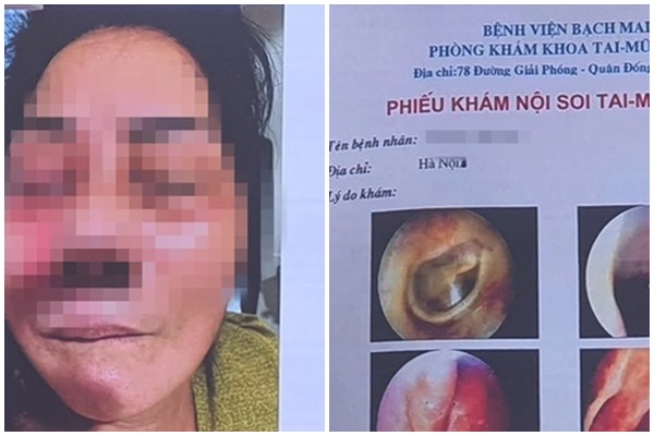 Nấm đen” khiến người bệnh hoại tử xương, tử vong có gì bí ấn?-3