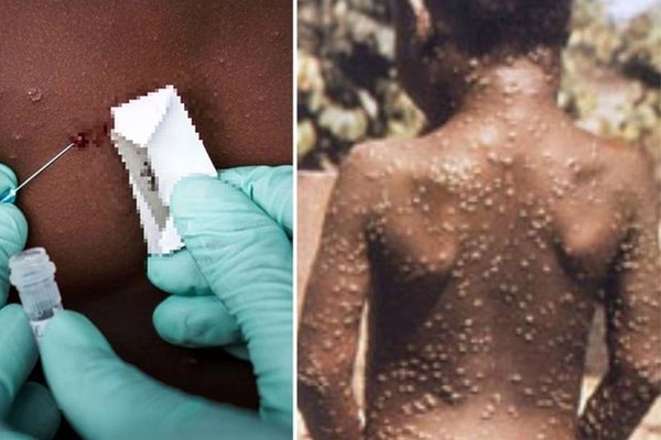 Tất cả những điều cần biết về căn bệnh WHO tuyên bố là tình trạng khẩn cấp toàn cầu: 4 đường lây truyền, 5 triệu chứng dễ nhầm lẫn-1