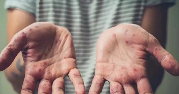 Tất cả những điều cần biết về căn bệnh WHO tuyên bố là tình trạng khẩn cấp toàn cầu: 4 đường lây truyền, 5 triệu chứng dễ nhầm lẫn-6