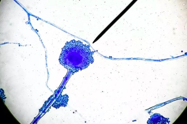 Nấm đen” khiến người bệnh hoại tử xương, tử vong có gì bí ấn?-1