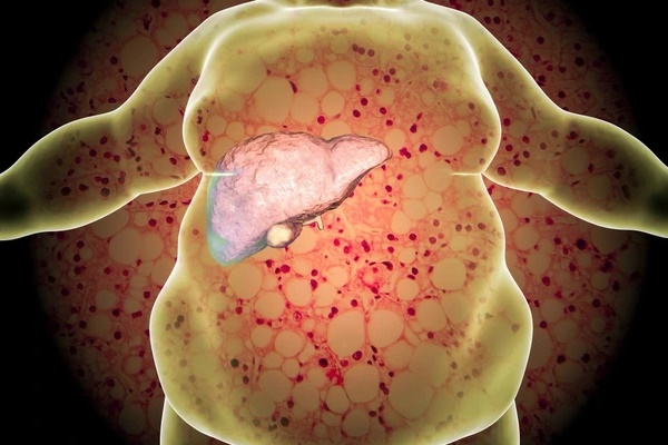 5 thói quen khi uống giúp bạn tránh xa gan nhiễm mỡ-1