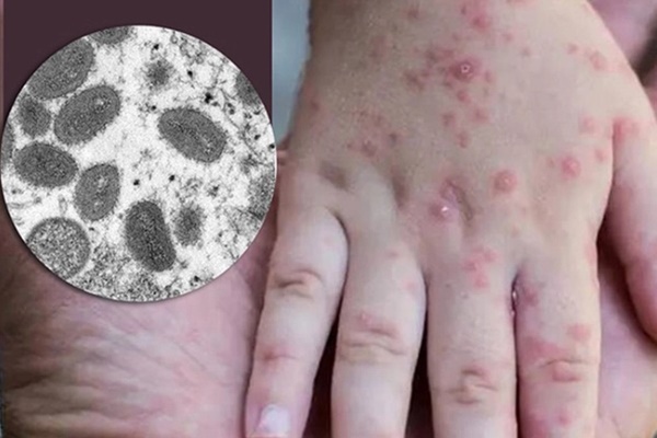 WHO: Giảm số bạn tình có thể hạn chế nguy cơ mắc bệnh đậu mùa khỉ-2