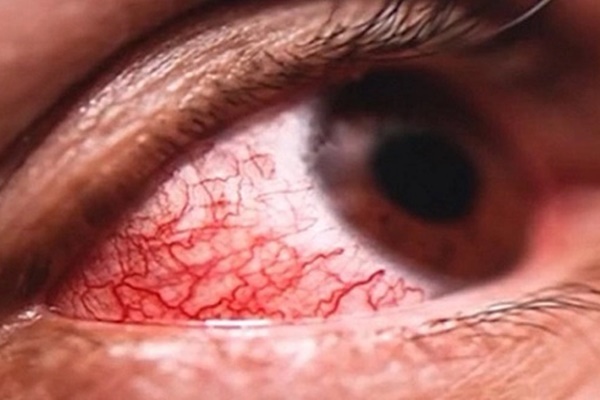 Châu Âu ghi nhận virus gây xuất huyết ở mắt, tỷ lệ tử vong đến 30%-1