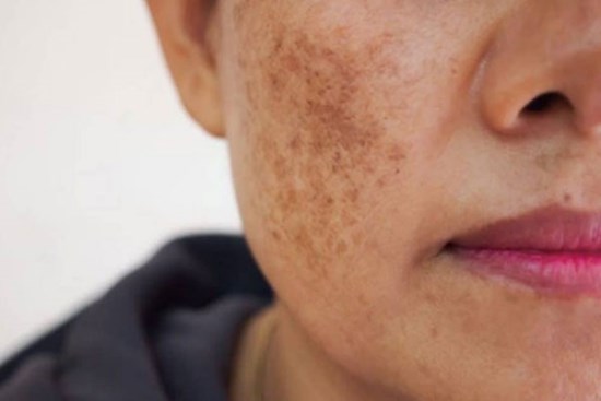 Tổng quan về nám da: Nguyên nhân, điều trị và biện pháp phòng ngừa