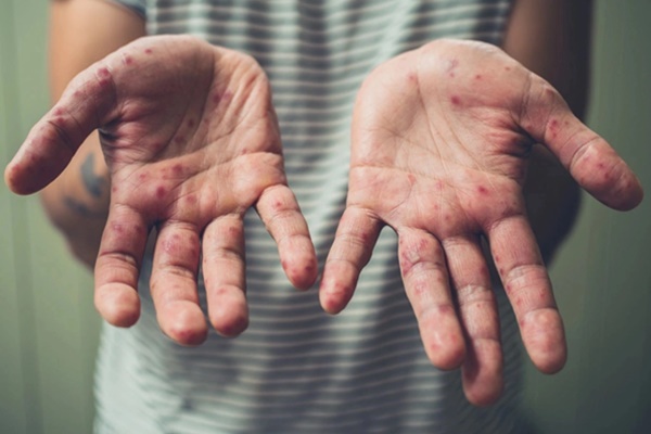 Thái Lan ghi nhận thêm ca mắc đậu mùa khỉ ở Bangkok-2