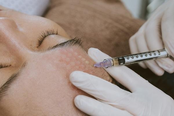 Phát hoảng với gương mặt tổ ong nghìn lỗ vì tiêm da meso-12
