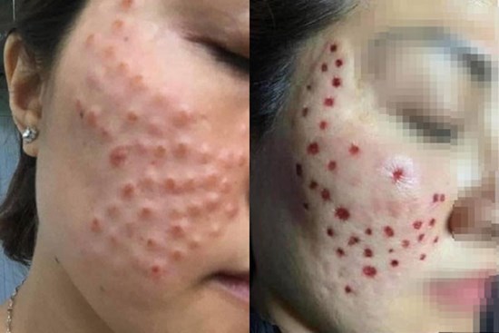 Phát hoảng với gương mặt 'tổ ong nghìn lỗ' vì tiêm da meso