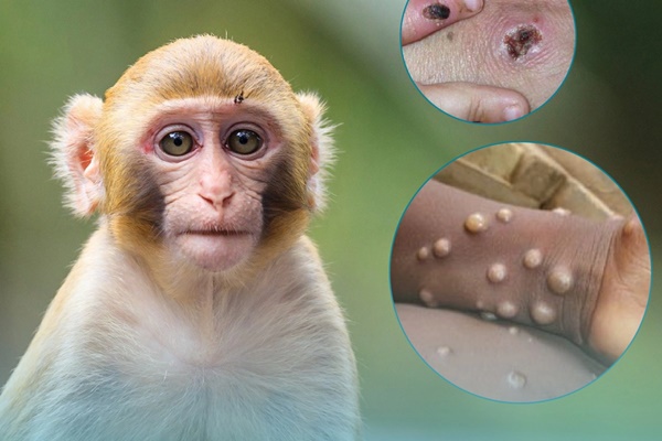 Nóng: Bộ Y tế ban hành hướng dẫn chẩn đoán, điều trị và phòng bệnh đậu mùa khỉ ở người-1