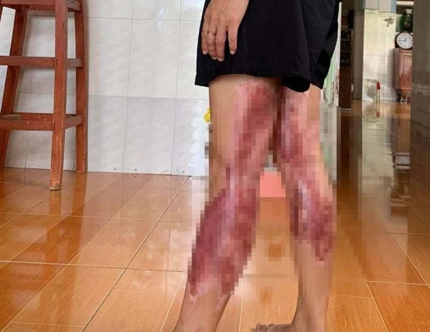 Một phụ nữ tố bị chồng cũ vác búa đuổi đánh, tạt nước sôi-1