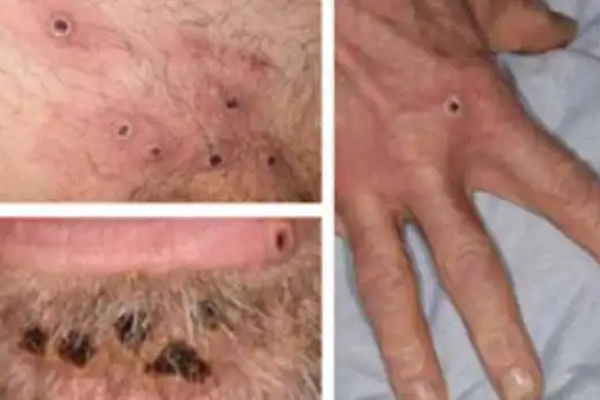 Người mắc bệnh đậu mùa khỉ cách ly tối thiểu 14 ngày và những điều cần biết để phòng tránh-5