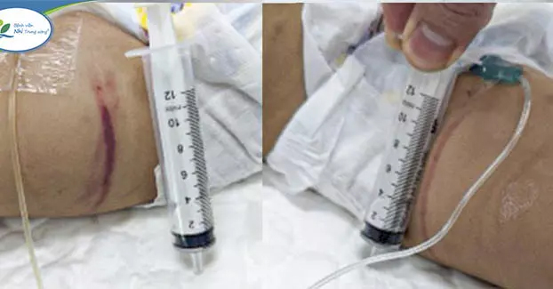 Hình ảnh vết lằn, bầm tím trên người bé 1 tuổi nghi bị bạo hành ở Hà Nội-2