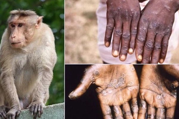 Mỹ ban bố tình trạng khẩn cấp toàn quốc vì bùng phát đậu mùa khỉ-3