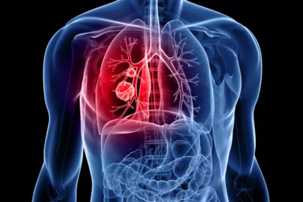 Các triệu chứng ban đầu của bệnh ung thư phổi cần đề phòng-2