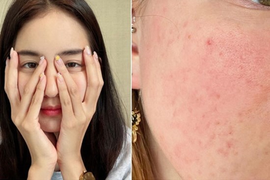 Có một tác nhân gây lão hóa da không thua gì tia tử ngoại mà chị em hay bỏ qua