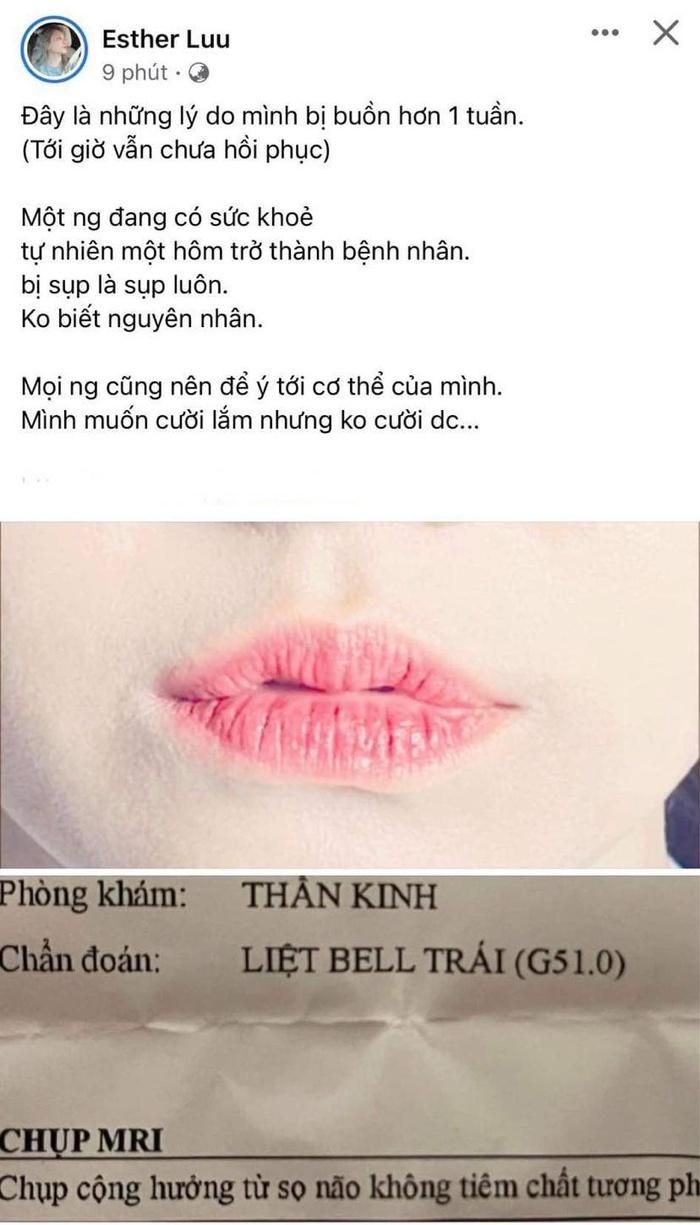 Hari Won - bà xã Trấn Thành bị liệt mặt trái-1