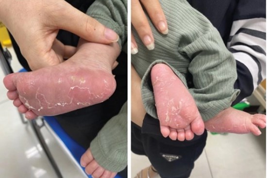 Bé trai 46 ngày tuổi mắc bệnh giang mai bẩm sinh