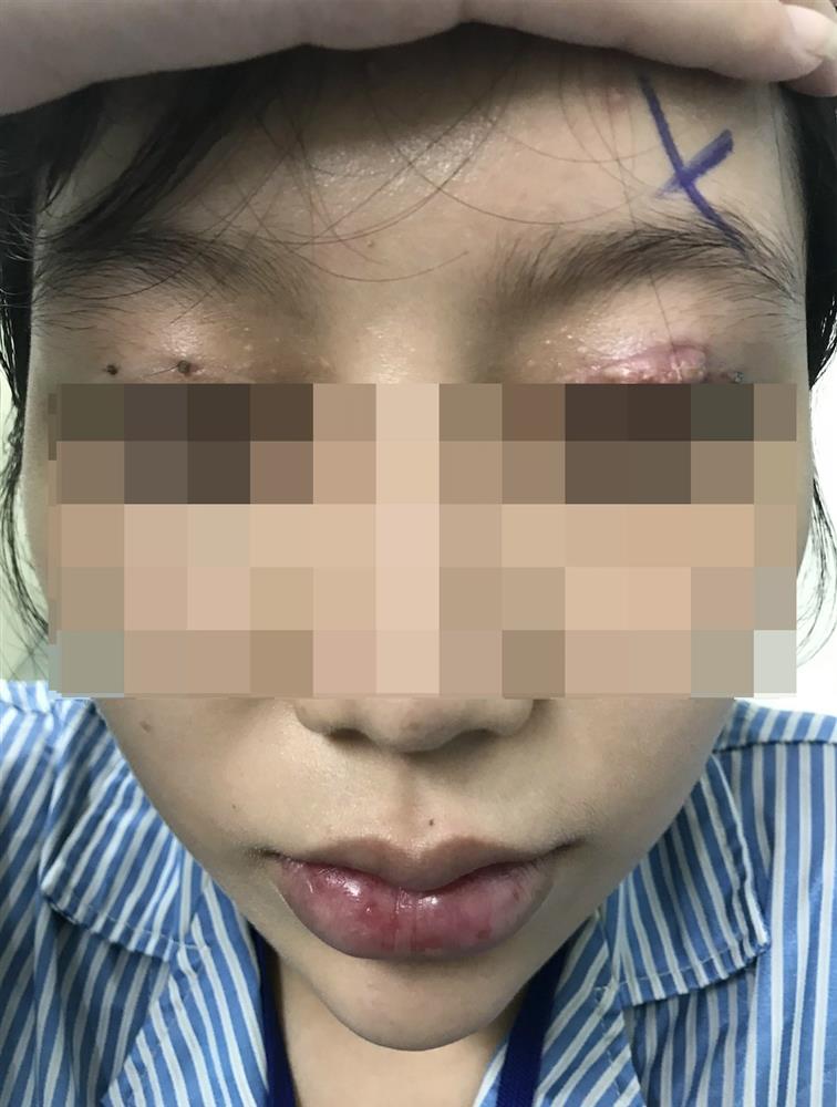 Cắt mí mắt ở cơ sở thẩm mỹ chui, một phụ nữ bị hỏng mắt-1