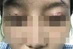 Cắt mí mắt ở cơ sở thẩm mỹ 'chui', một phụ nữ bị hỏng mắt