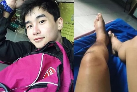 Nam diễn viên 24 tuổi qua đời vì ung thư da, chuyên gia chỉ rõ 5 cách phòng bệnh giới trẻ tuyệt đối không chủ quan!