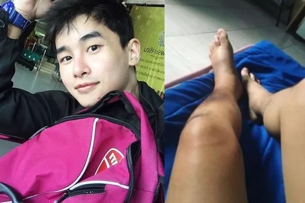 Nam diễn viên 24 tuổi qua đời vì ung thư da, chuyên gia chỉ rõ 5 cách phòng bệnh giới trẻ tuyệt đối không chủ quan!-1