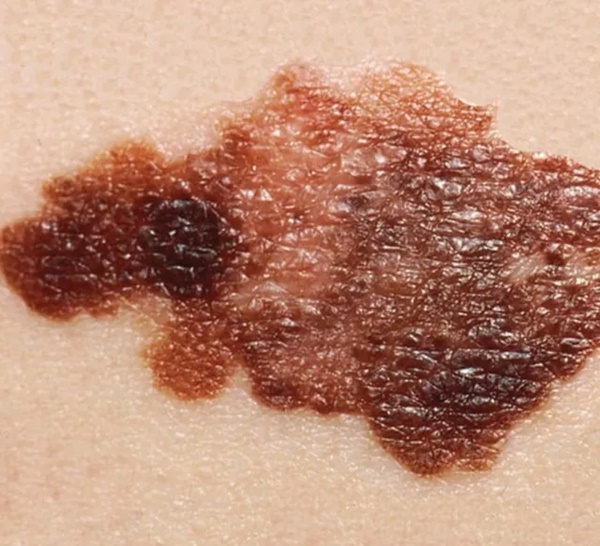 Nam diễn viên 24 tuổi qua đời vì ung thư da, chuyên gia chỉ rõ 5 cách phòng bệnh giới trẻ tuyệt đối không chủ quan!-2