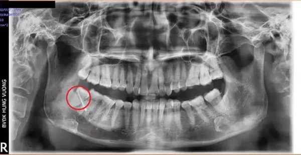 Hy hữu: Bệnh nhân bị... thủng má do biến chứng răng số 48 mọc lệch-2