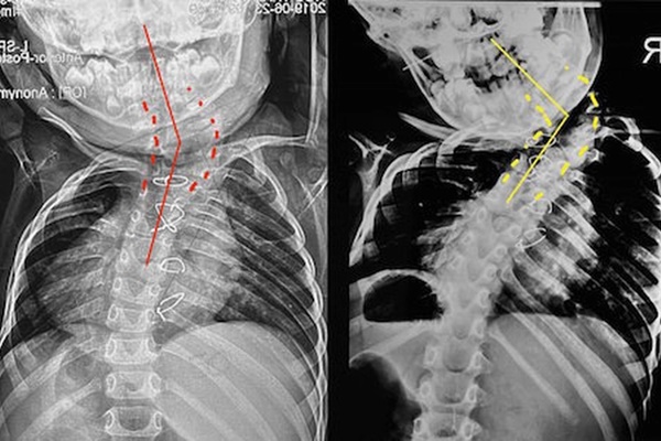 Bé trai 6 tuổi bị biến dạng vẹo lệch cột sống - lời cảnh báo cho các bậc cha mẹ-1