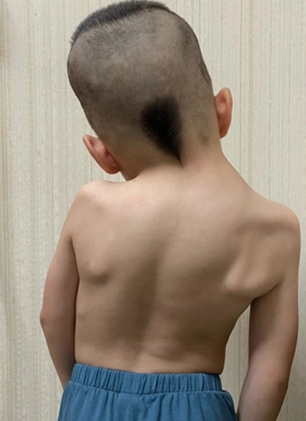 Bé trai 6 tuổi bị biến dạng vẹo lệch cột sống - lời cảnh báo cho các bậc cha mẹ-2