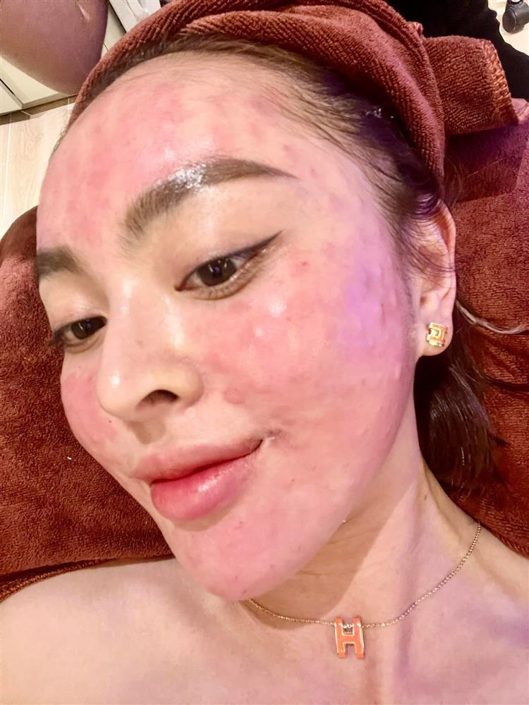 Trang Nemo xuất hiện với mặt tiền như bị bỏng nặng-1