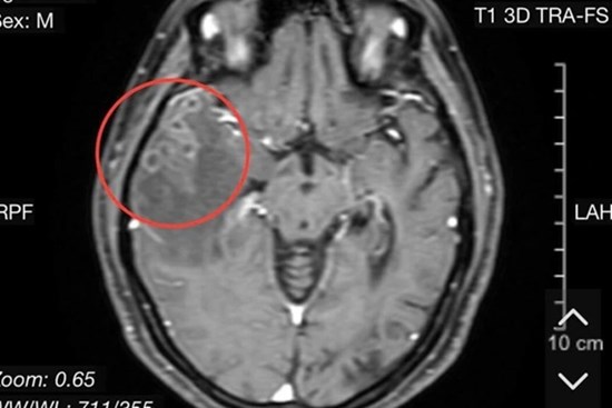 Lại thêm một ca sán làm tổ trong não bệnh nhân