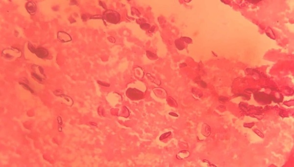 Lại thêm một ca sán làm tổ trong não bệnh nhân-2