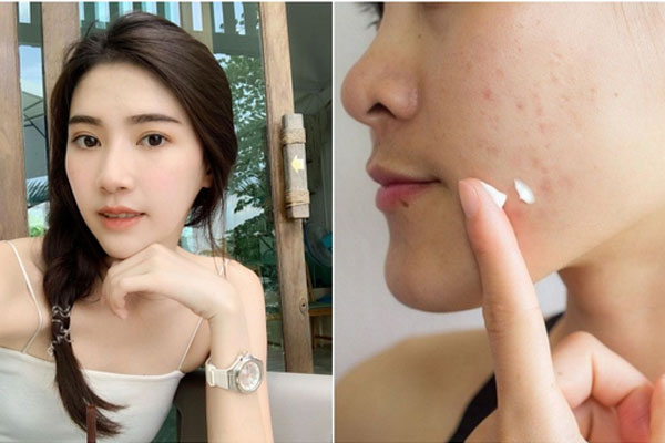 Mùa hè khiến da nổi mụn trứng cá gây mất thẩm mỹ, muốn khắc phục tận gốc, chị em cần lưu ý 5 điều-6