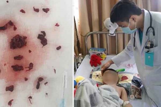 Bé trai 4 tuổi bị đột quỵ sau khi mắc COVID-19